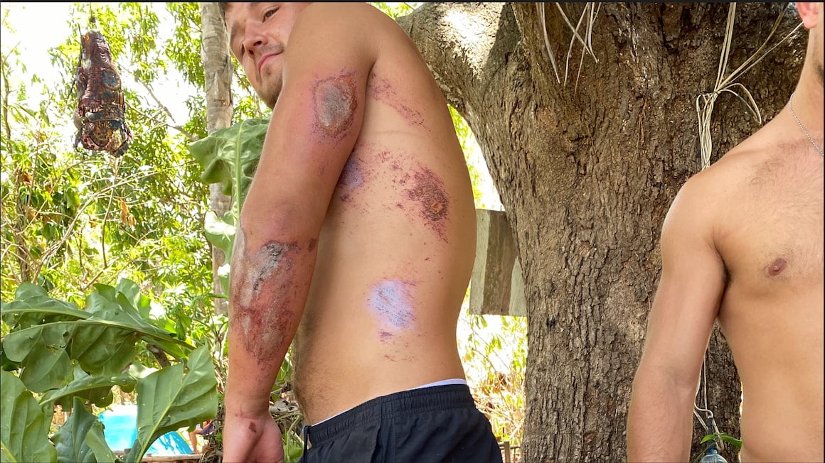 guy with road rash after crashing moped in jungle