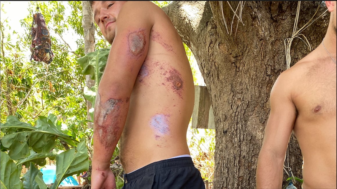 guy with road rash after crashing moped in jungle 