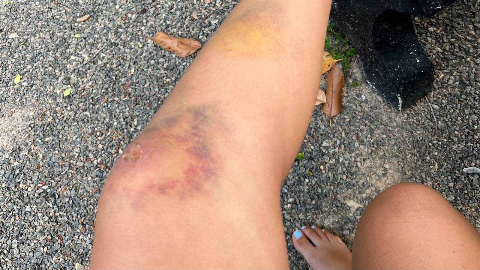 Left knee and leg covered in large red and purple bruises